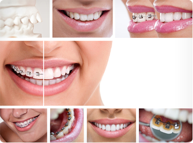 castle pines orthodontist for braces and orthodontics